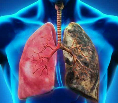 New Diseased Cell Additions to Lung and Airway Catalog