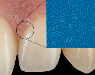 fibroblasts dermal fibrotic